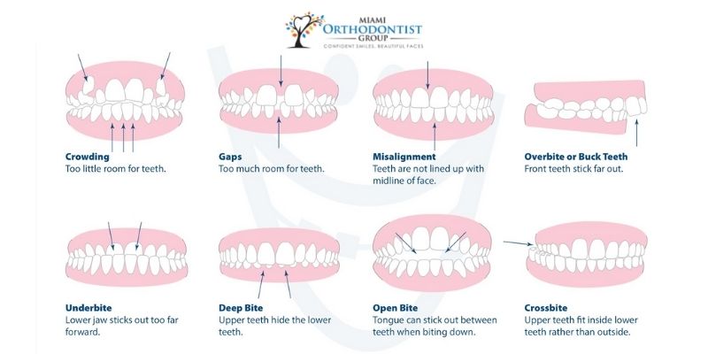 Types Of Bite Problems That Requires Braces