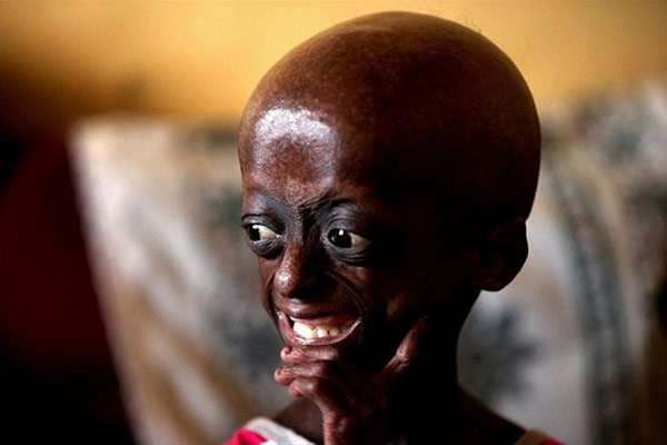 Ontlametse Phalatse Progeria