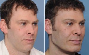 Male Custom Infraorbital and Jawline Implant results right oblique view Dr Barry Eppley Indian