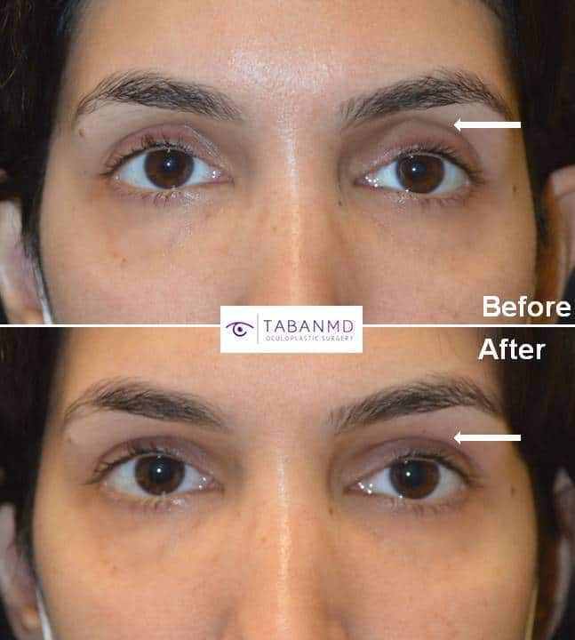 Upper eyelid filler1