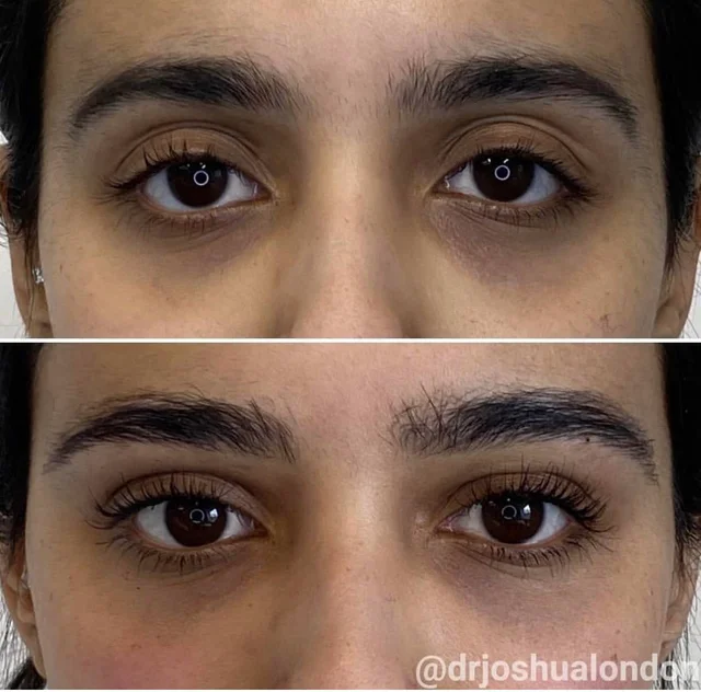 Upper eyelid filler3
