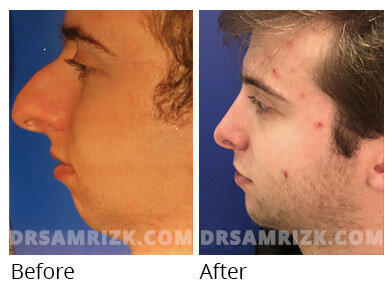 Looksmax male rhinoplasty patient 037 1