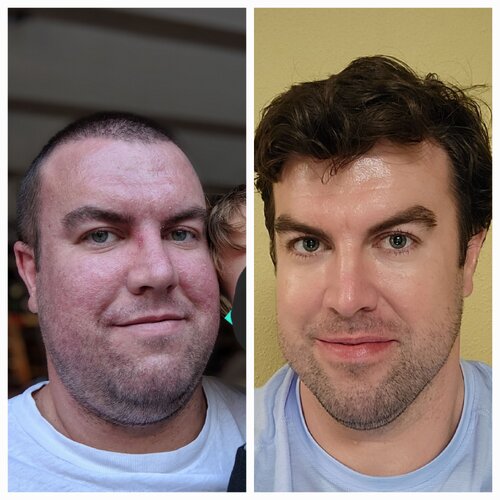 3 year progression age 37 tretinoin vbeam v0 3whjz6041sj91