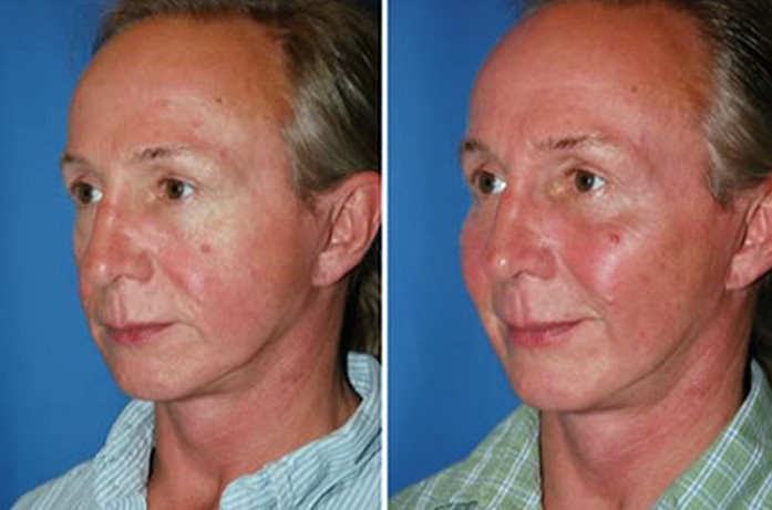 Submalar implants man