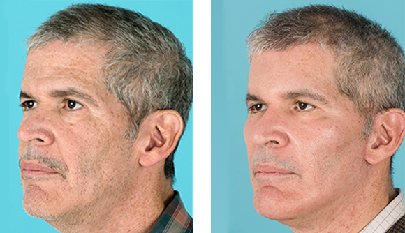 Malar shell implant1