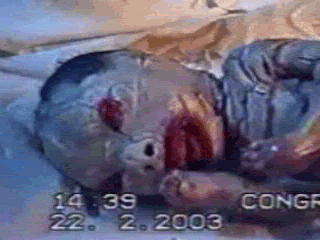 Harlequin fetus