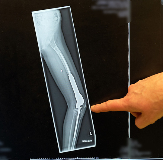 Limb salvage callout