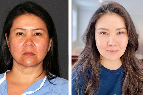 Best asian facelift results nyc 1