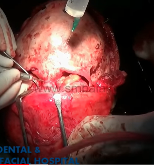 SURGERY
