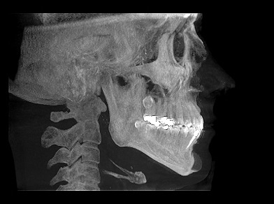 Thumbnail Lateral Ceph X Ray