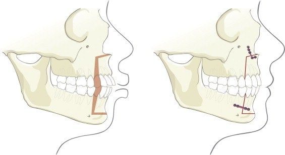 1763312 gr1 145 1