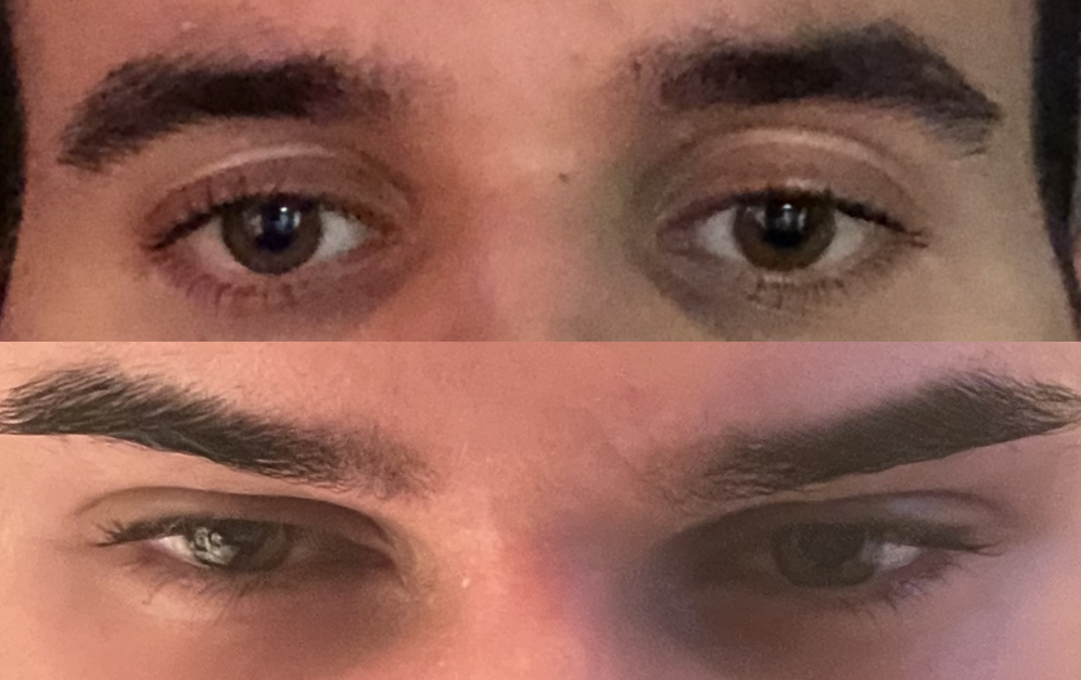 Canthoplasty browlift