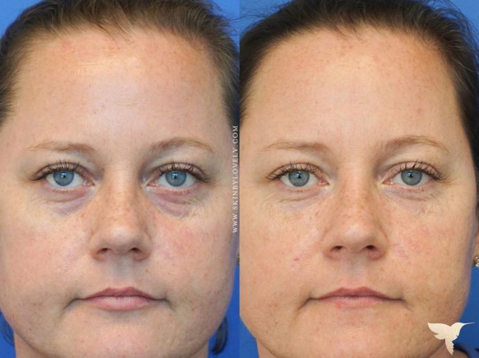SkinbyLovely Treatment UnderEyes 690x515