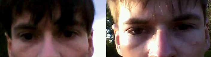 Infraorbital implants