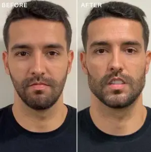 Jawline filler