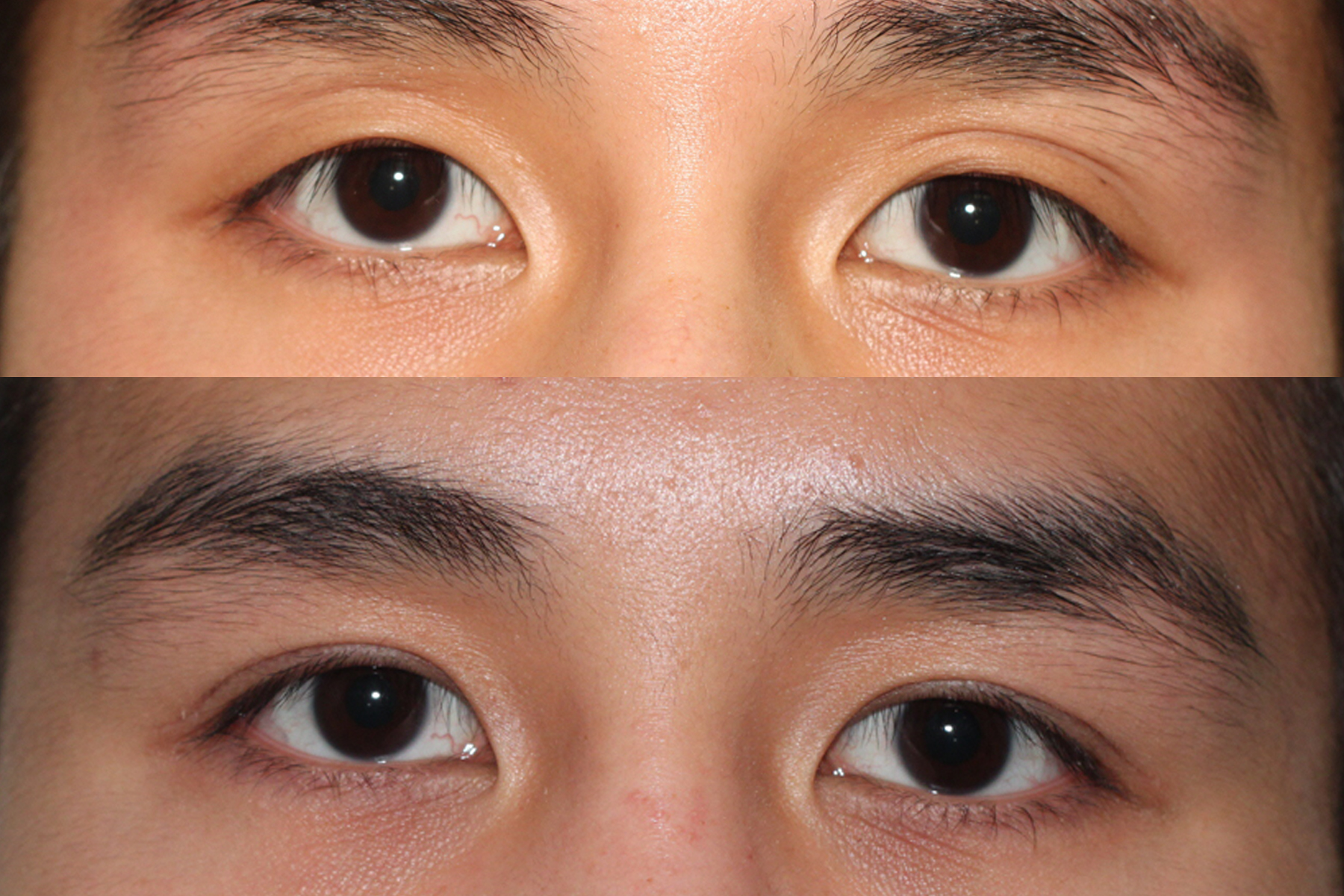 TC before after bleph