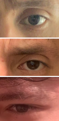 3497295 botox on hollow eye