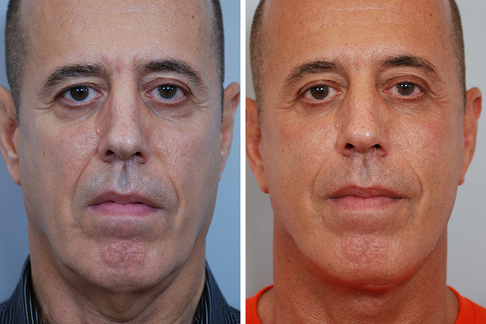 Facelift71 mens