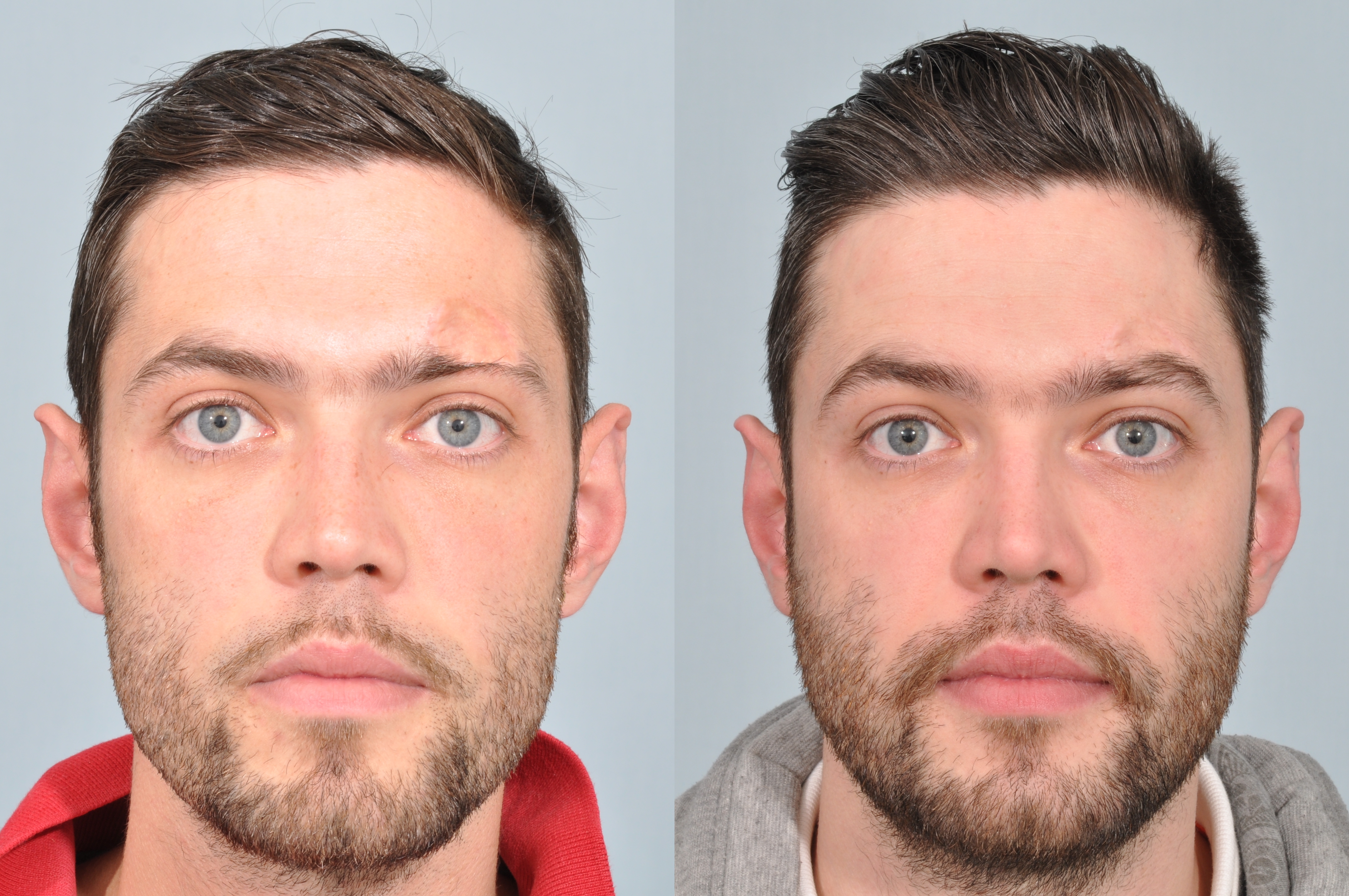 2013 03 19 maleeyebrowtransplant maleeyebrowtransplant