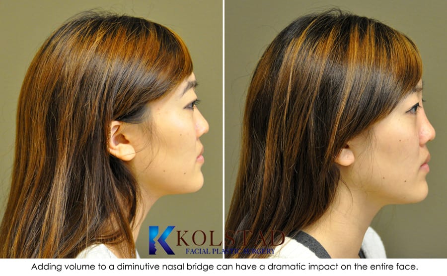 Asian rhinoplasty san diego la jolla carlsbad non surgical nose job injectable filler cost pri