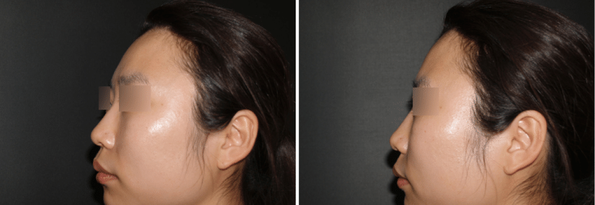 Photographs show a typical Asian nose with a flat nasal dorsum and tip Asians typically