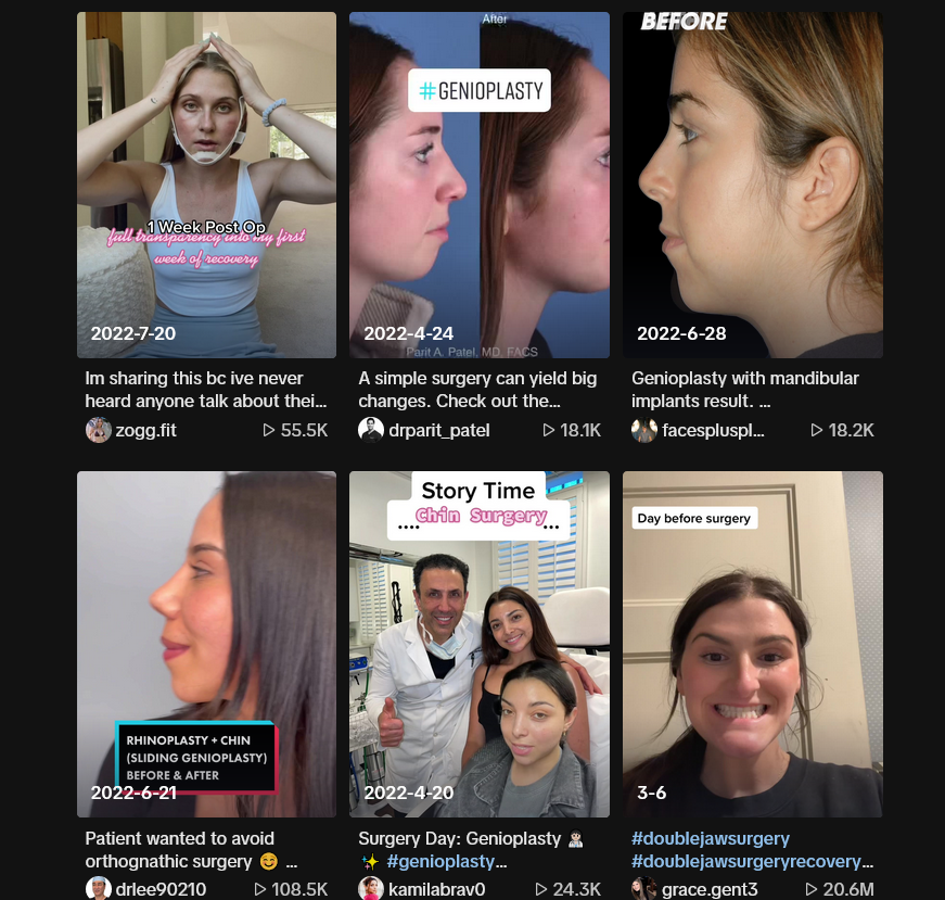 Screenshot 2023 07 31 at 13 39 02 Find genioplasty on TikTok TikTok Search