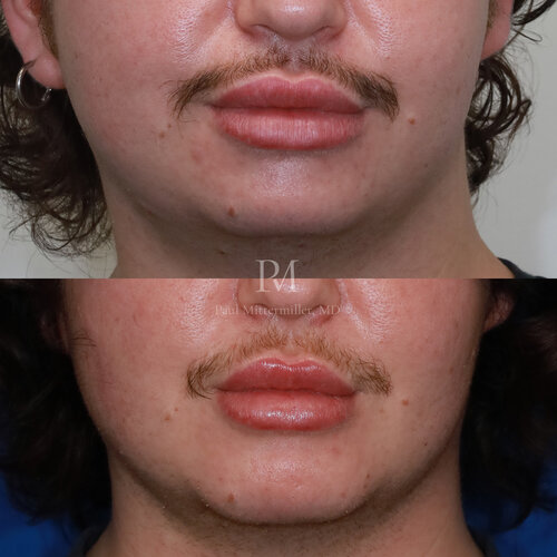 Mittermiller jaw implant 230203 1 month postop 1 100
