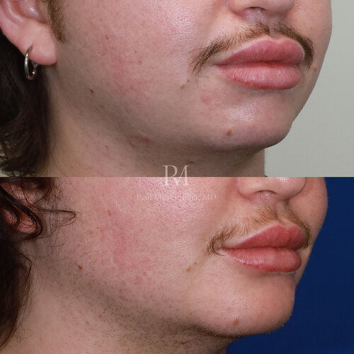 Mittermiller jaw implant 230203 1 month postop 2 100