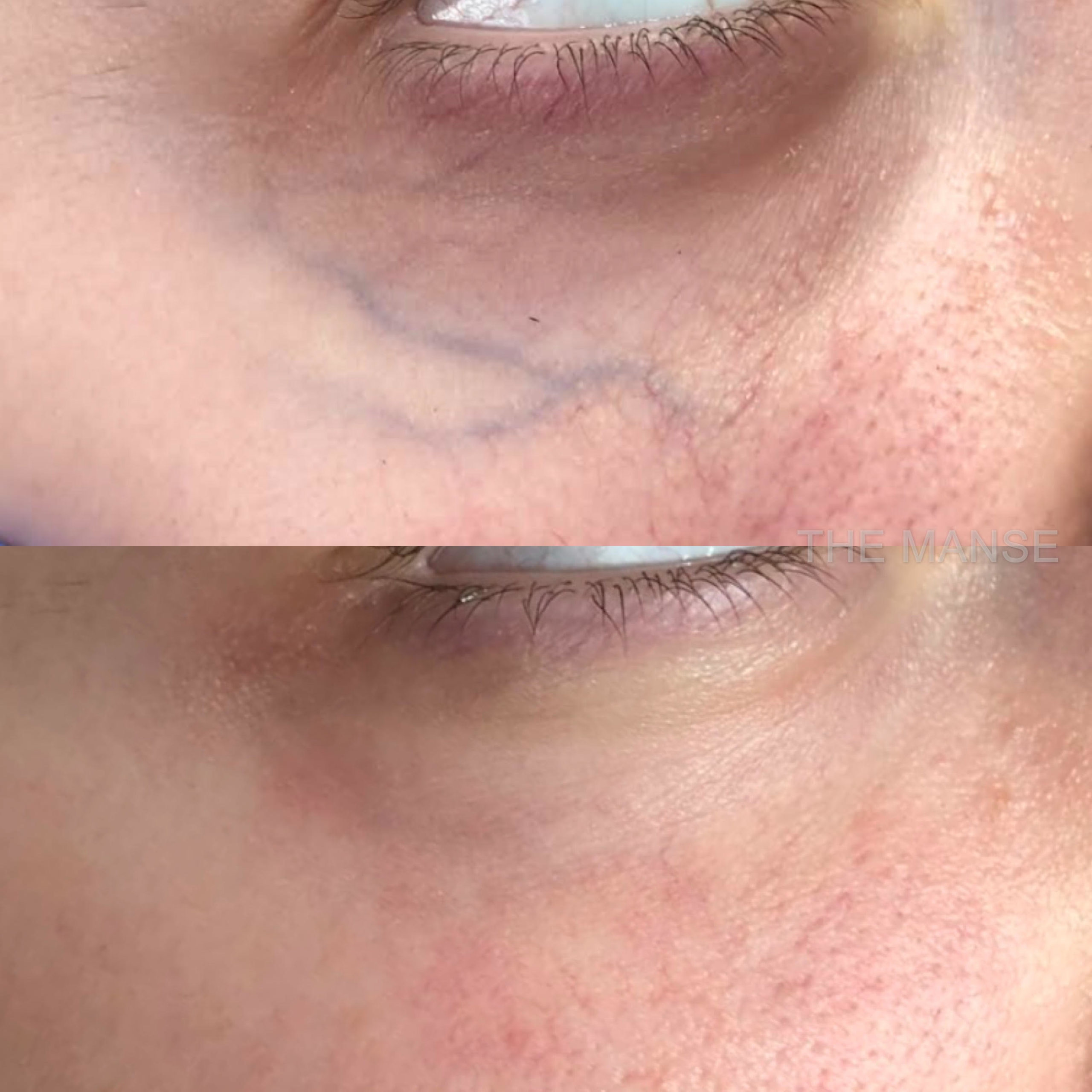 Blue vein remocal under eye scaled
