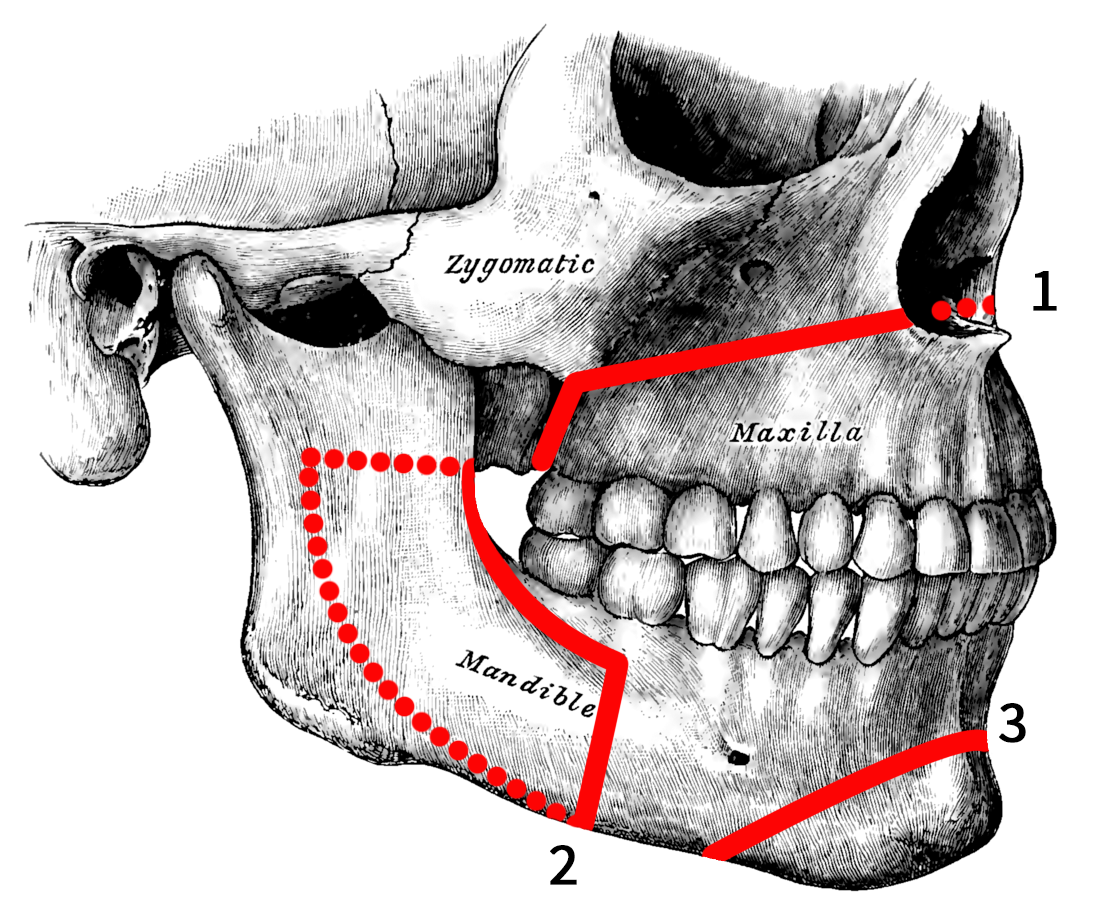 3256737 Orthognatic surgery