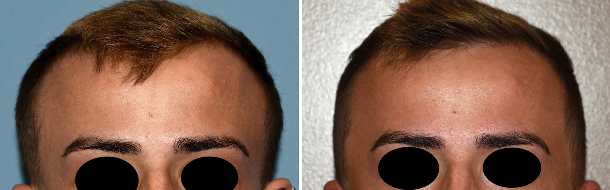 Male Temporal Reduction result front view Dr Barry Eppley Indianapolis