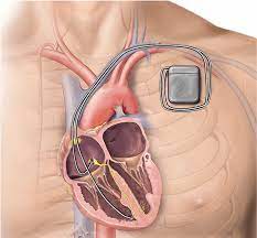 Inserting an internal cardioverter defibrillator | healthdirect