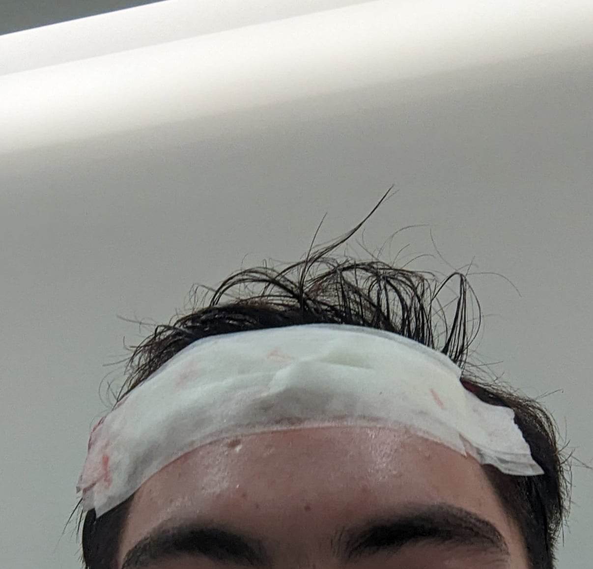 3233229 forehead