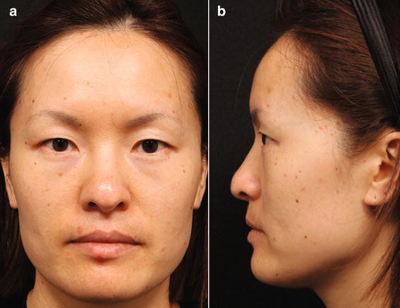 Asian profile flat maxilla