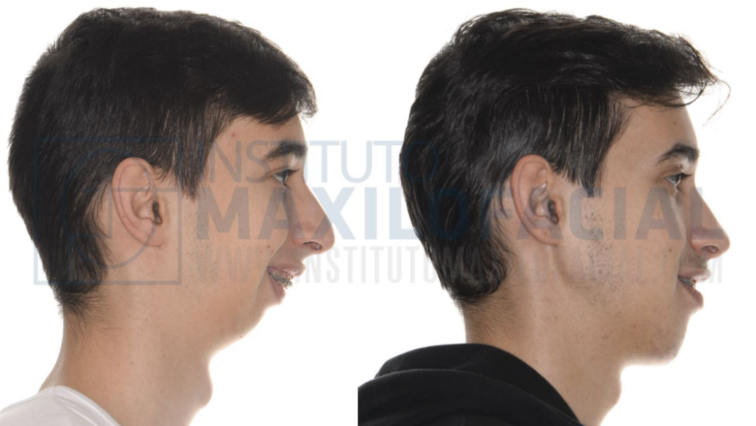 Recedad Most receded jaw ever (nonexistent jaw) | Looksmax.org - Men's Self ...