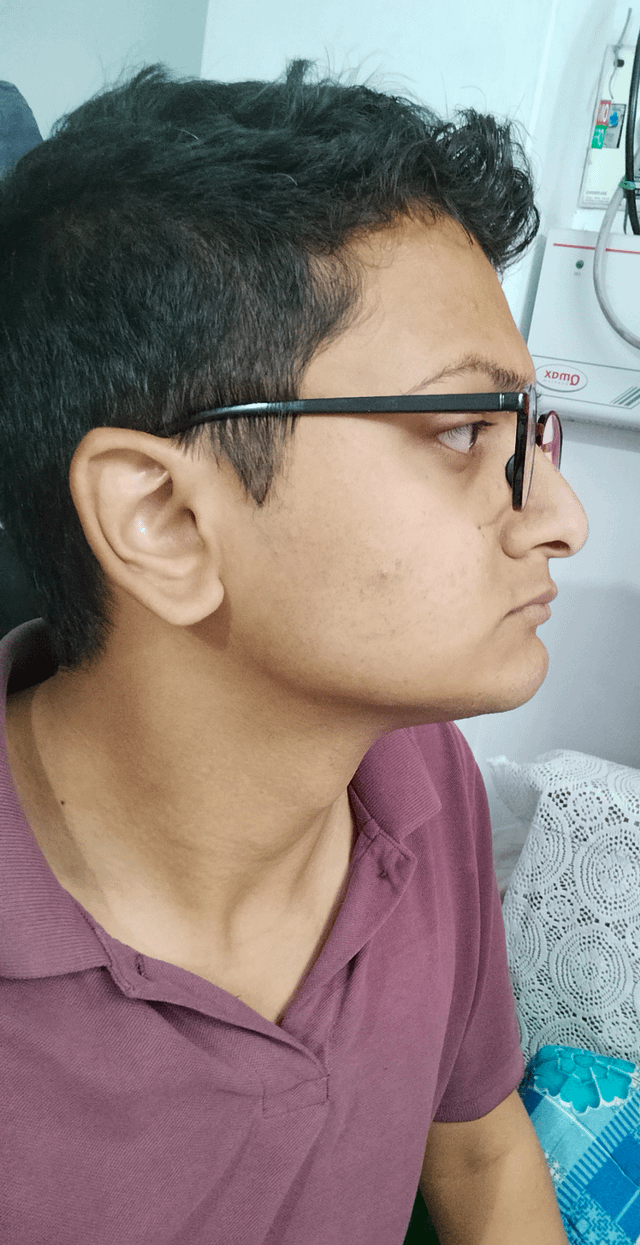 Do i have short face syndrome my chin is hardly 2cm long v0 tlpl78chzdna1