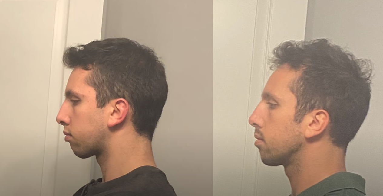 Rate mewing results | Looksmax.org - Men's Self-Improvement & Aesthetics