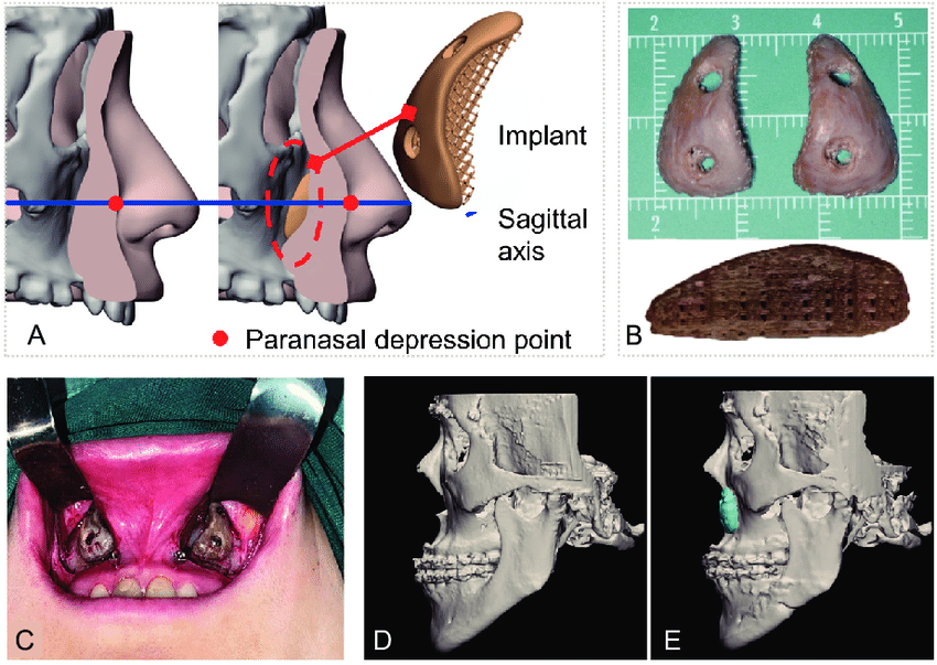 Design and application of an implant for paranasal augmentation A Pre operative design