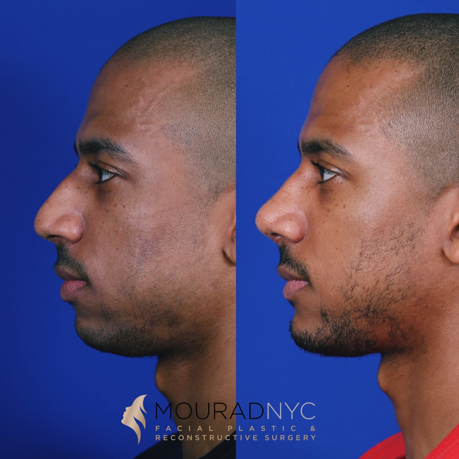 Sliding Genioplasty and Rhinoplasty Before and After