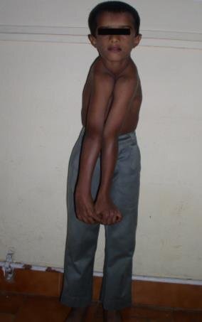 Approximation of both the shoulders at midline