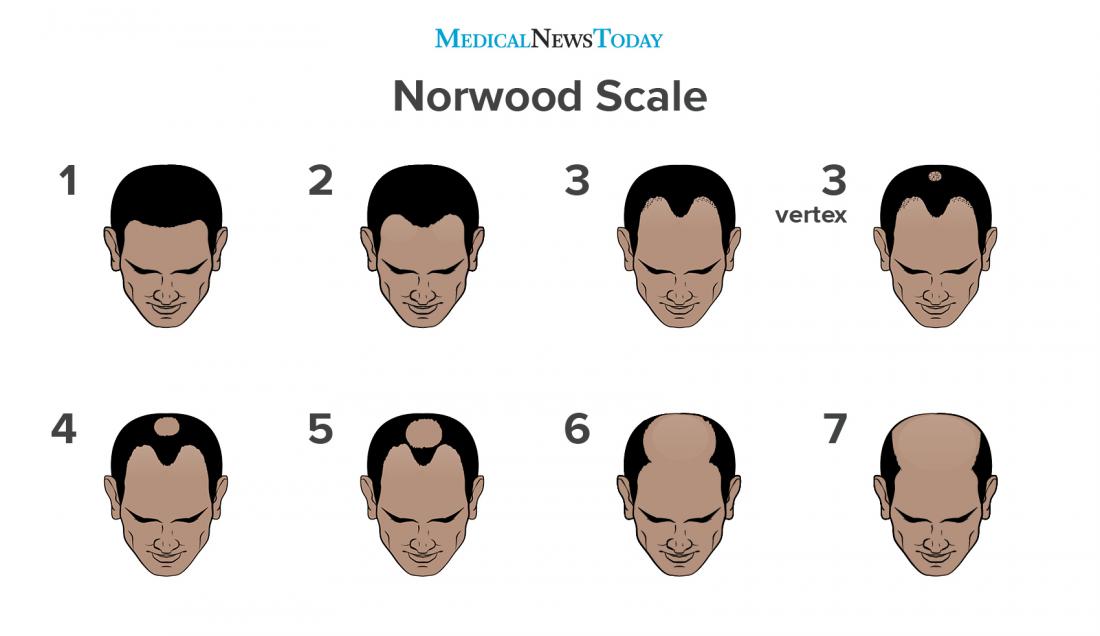 An infographic of the norwood scale