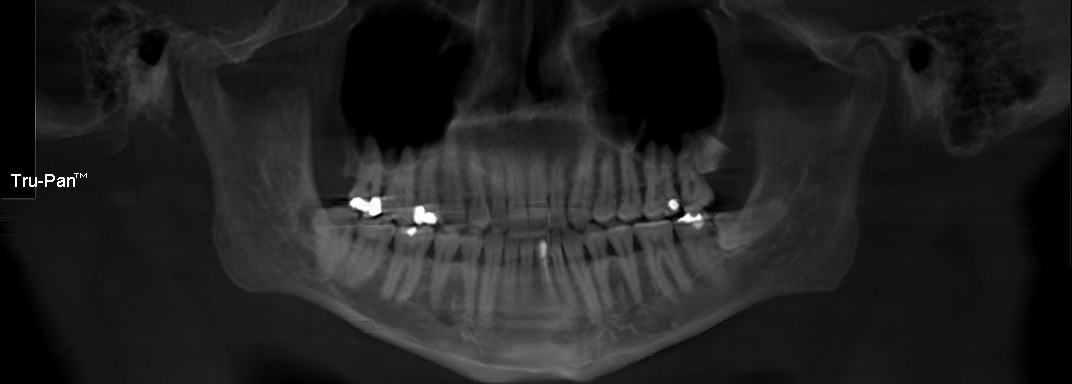 Thumbnail Panoramic X Ray