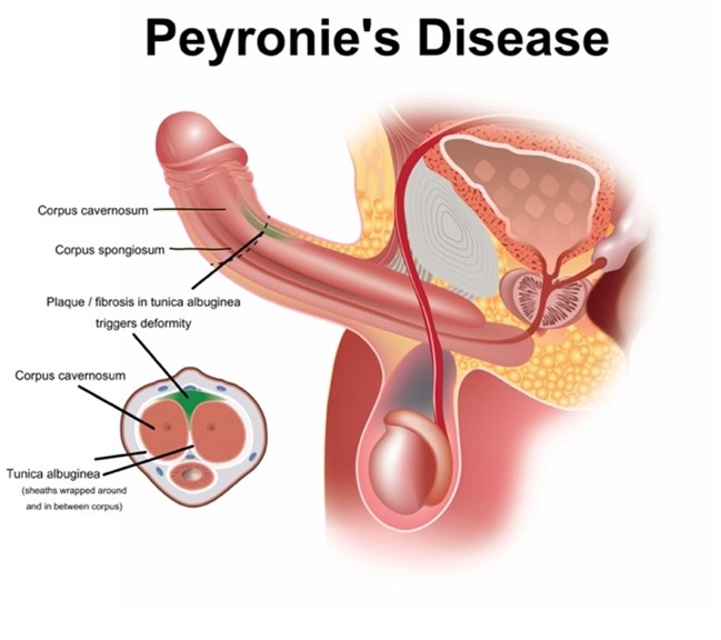 Peyronies Disease Image Infographic