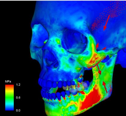 FEA Skull
