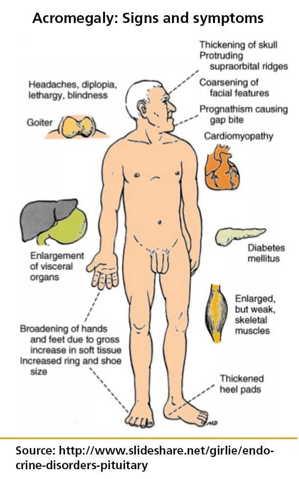 Acromegaly Signs And Symptoms