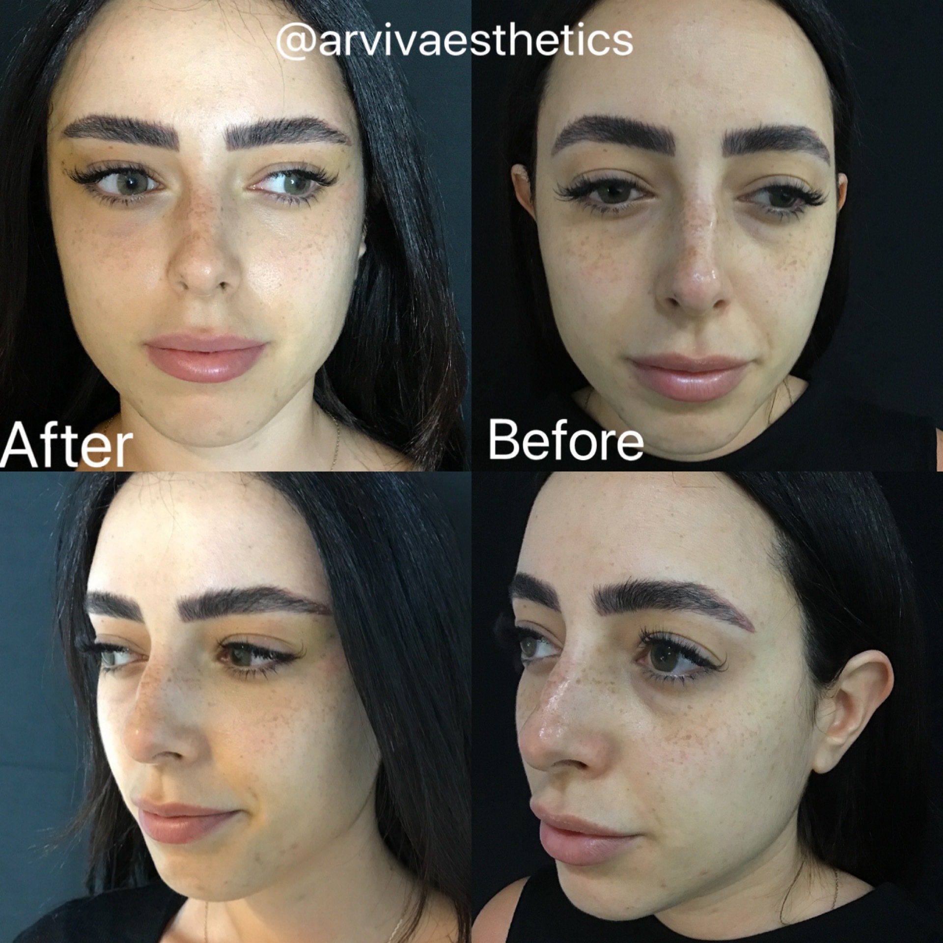Canthoplasty