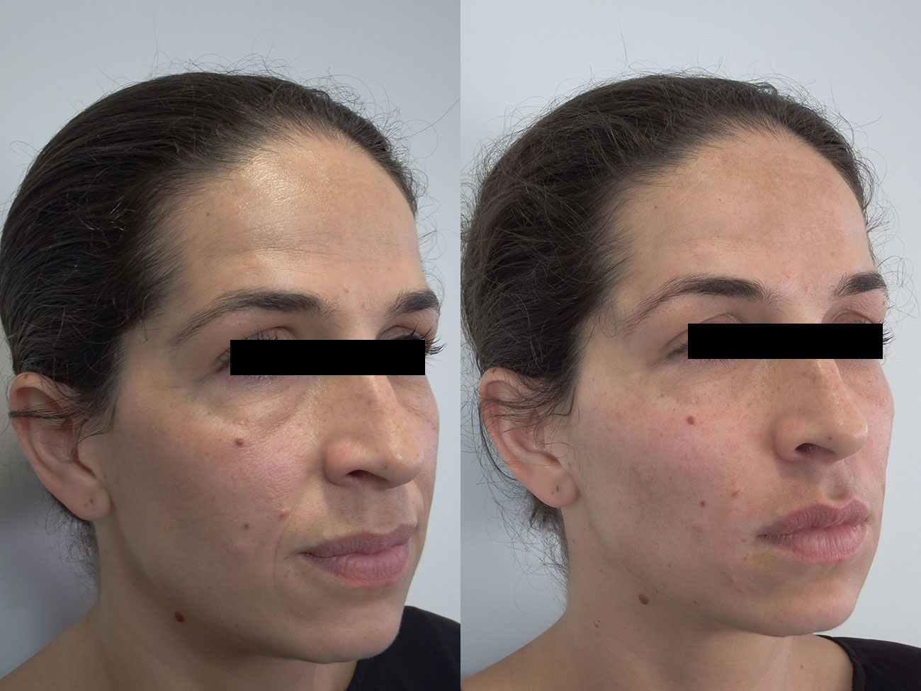 Nasolabial filler1