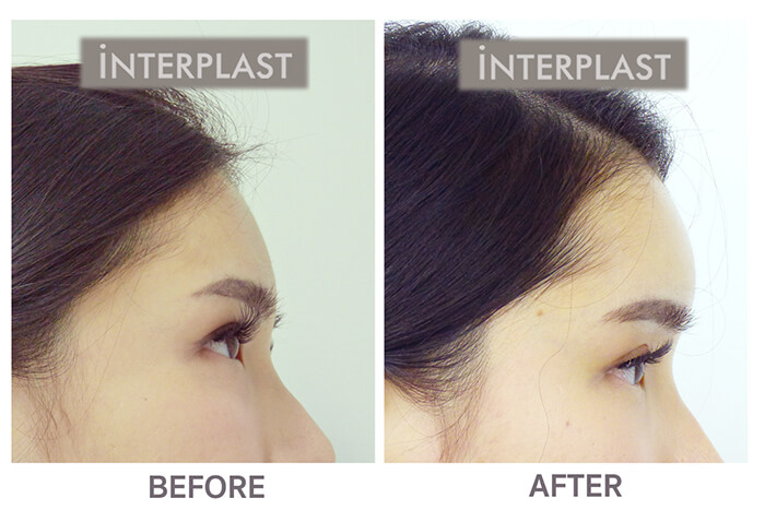 Forehead augmentation in bangkok02