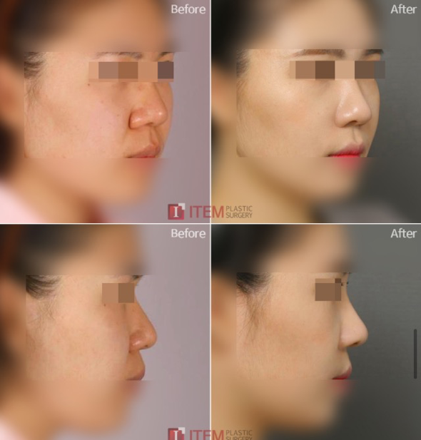 Paranasal implant2