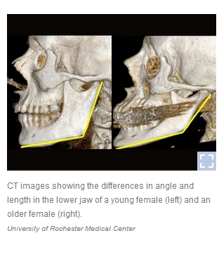 Skull aging